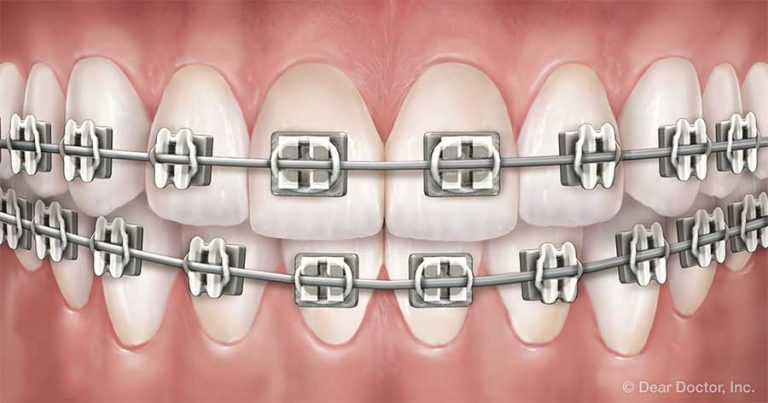 關於箍牙治療你應該知道的事
